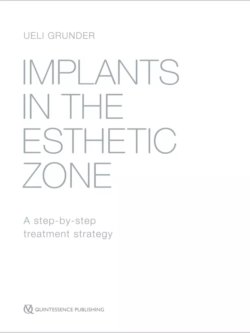 implants in the esthetic zone